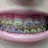 A close-up of a mouth with braces, next to red pixelated text reading 'MY GRILLS' on black background.